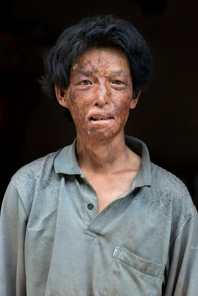 Zheng Lie Wen (50), burned by wok accident, Jiaju, China, 2013